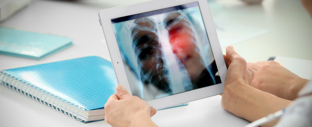 Tackling the Lung Cancer Survival Rate