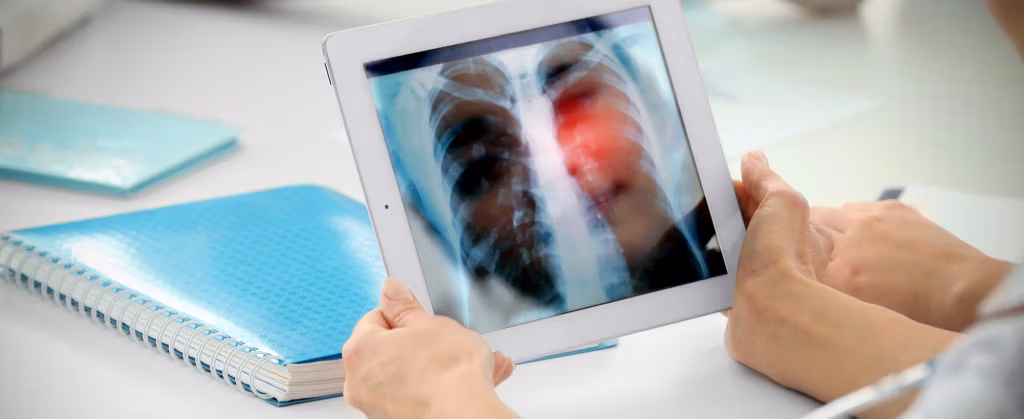 Tackling the Lung Cancer Survival Rate